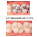 ΠΡΙΝ ΚΑΙ ΜΕΤΑ – Athens Dental Care